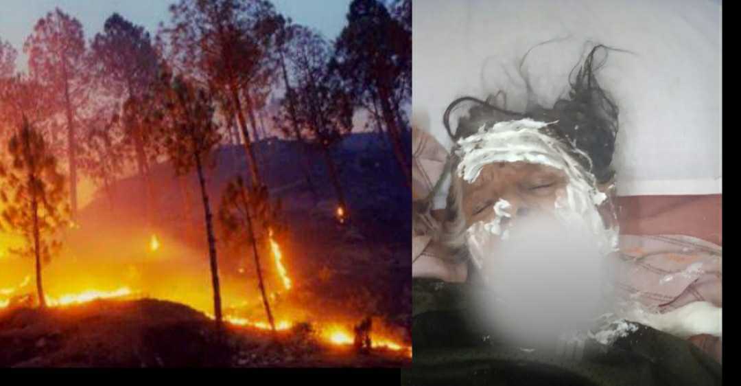 Uttarakhand: Gomti Devi of almora bhikyashen scorched badly due to forest fire