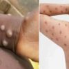 Uttarakhand monkey pox symptoms