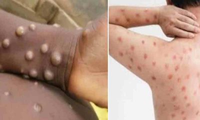 Uttarakhand monkey pox symptoms