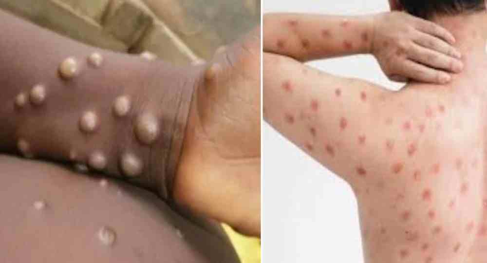 Uttarakhand monkey pox symptoms