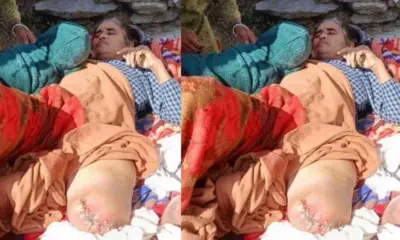 Pithoragarh news today: Nirmala Devi became disabled due to poor health system in jhulaghat leg cut uttarakhand live