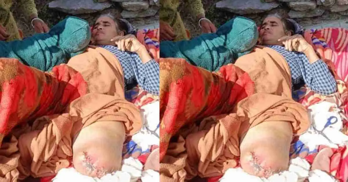 Pithoragarh news today: Nirmala Devi became disabled due to poor health system in jhulaghat leg cut uttarakhand live