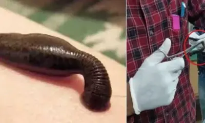 Chamoli News today: Leech came out of the nose of an 11-month-old child in karnprayag uttarakhand breaking live update