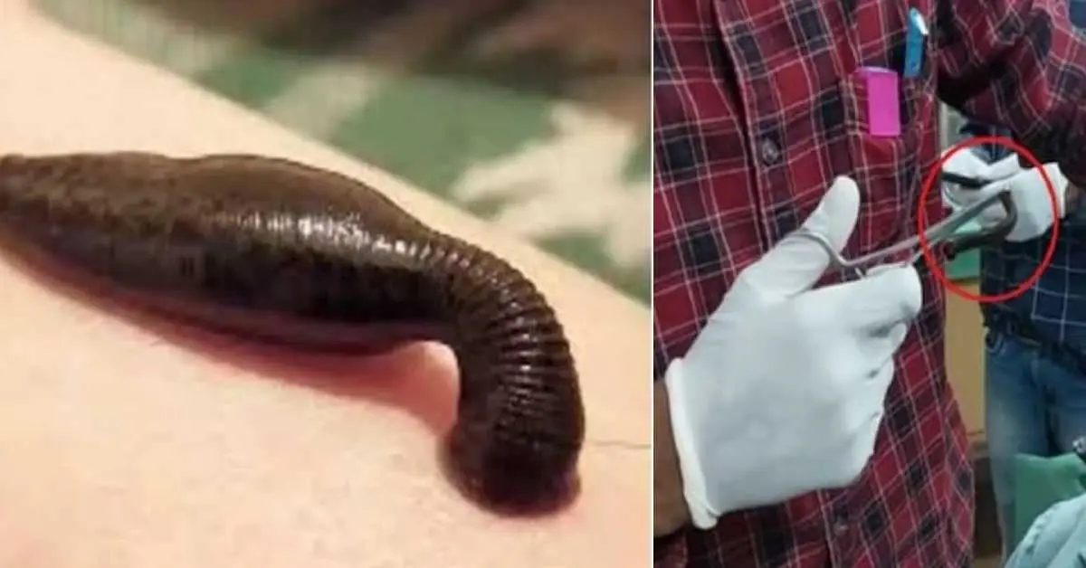 Chamoli News today: Leech came out of the nose of an 11-month-old child in karnprayag uttarakhand breaking live update