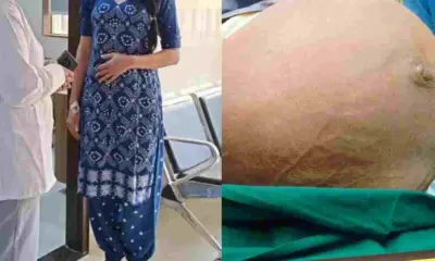 Uttarakhand news: Dehradun Broad Ligament Fibroid Surgery Doctors Remove 4.5 Kg Fibroid Mistaken for Pregnancy