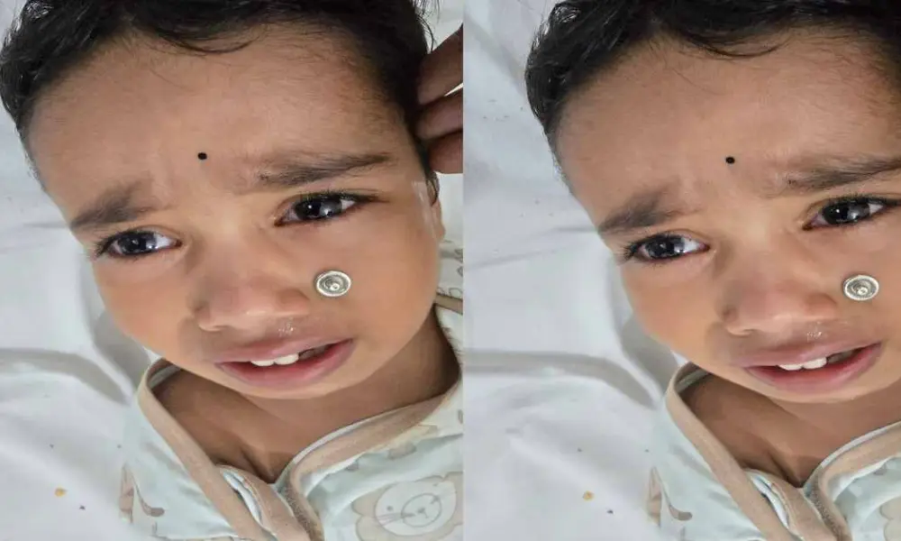 Champawat news today: doctor removed a foreign metal button from a 2-year-old child's nose in sub district hospital Tanakpur.