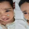Champawat news today: doctor removed a foreign metal button from a 2-year-old child's nose in sub district hospital Tanakpur.