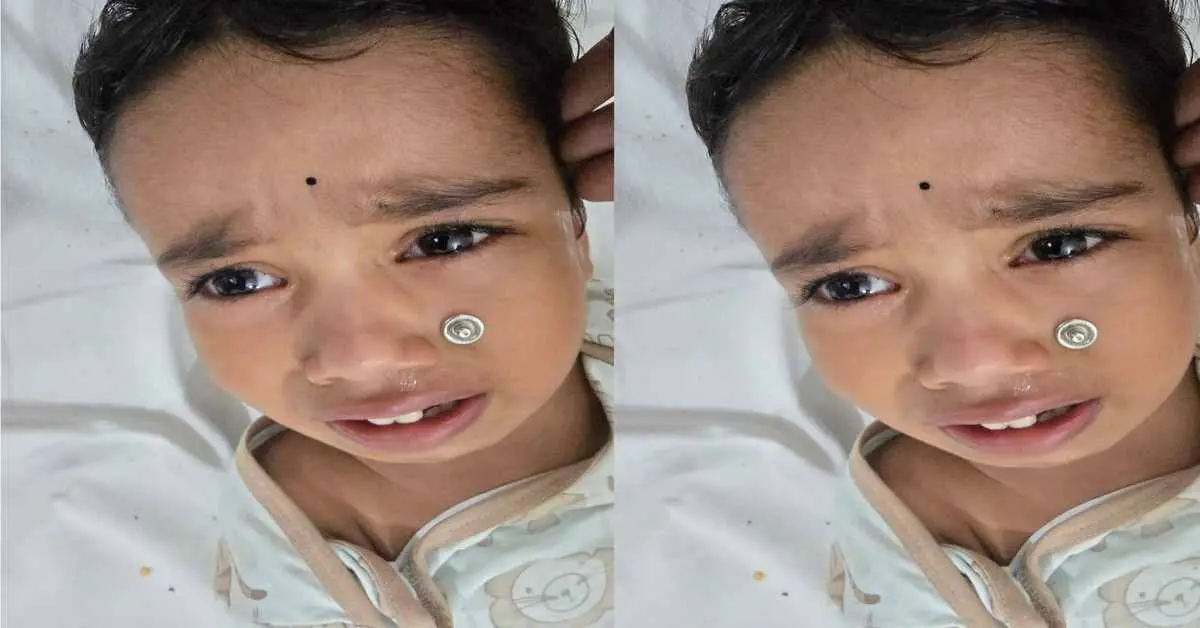 Champawat news today: doctor removed a foreign metal button from a 2-year-old child's nose in sub district hospital Tanakpur.